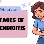 4 Stages of Appendicitis